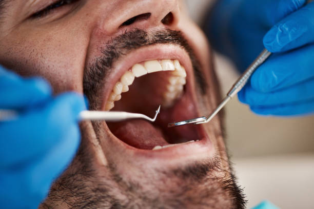 Best Dentist for Tooth Abscess  in Forest, MS